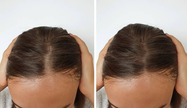 Iron Deficiency and Hair Loss: Causes, Symptoms, and IV Solutions