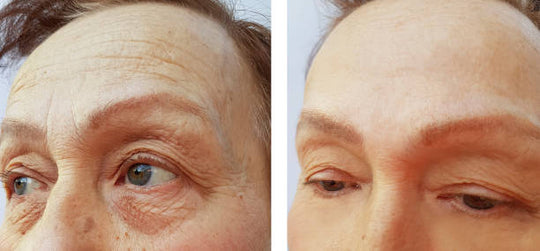 Botox
