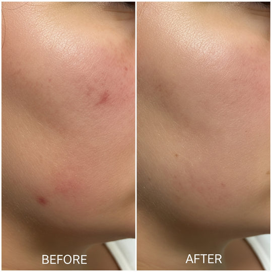 Skin Enhance: VI Peel