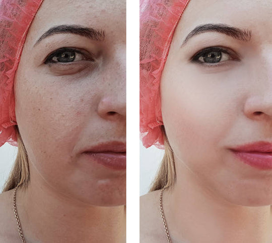 Skin Enhance: VI Peel